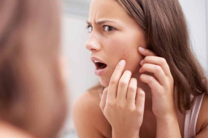 get rid of blackheads get rid of blackheads